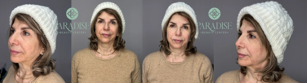کوکتلهای مزوتراپی و مزونیدلینگ