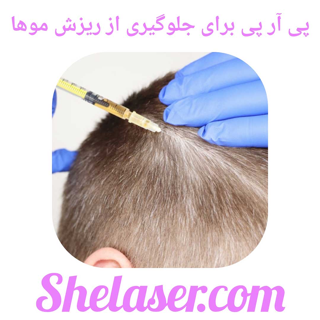 پی آر پی ریزش مو