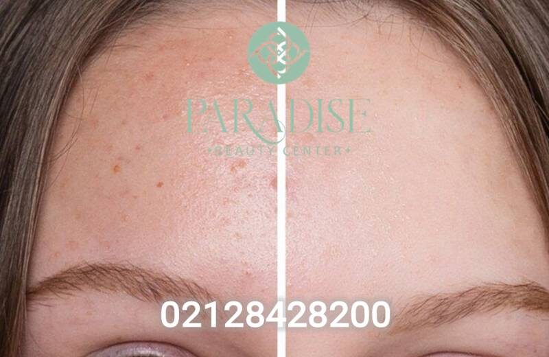 عکس قبل و بعد تزریق بایوژل