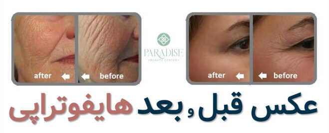 عکس قبل و بعد هایفوتراپی