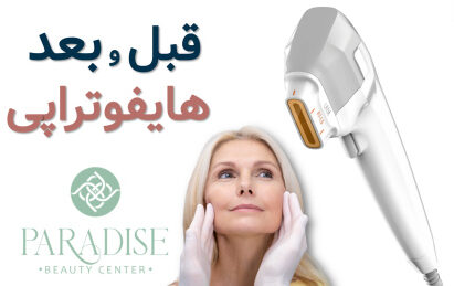 عکس قبل و بعد هایفوتراپی