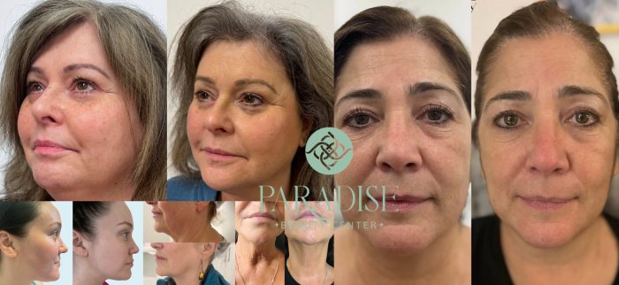عکس قبل و بعد هایفو