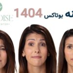هزینه بوتاکس 1404