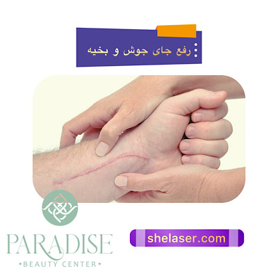 رفع جای جوش و بخیه