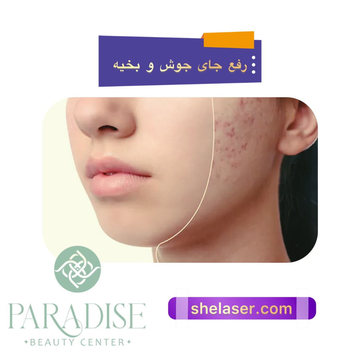 رفع جای جوش و بخیه