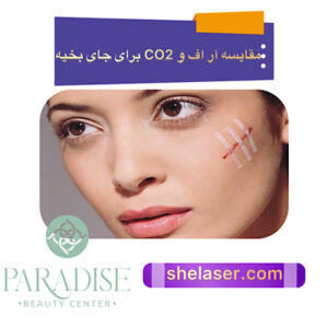 مقایسه آر اف و CO2 برای جای بخیه