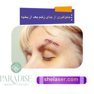 جلوگیری از جای زخم بعد از بخیه
