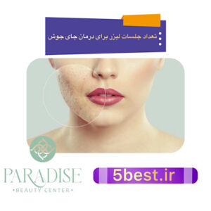 تعداد جلسات لیزر برای درمان جای جوش