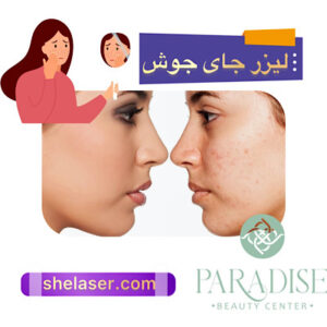 لیزر جای جوش