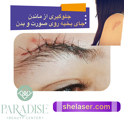 جلوگیری از ماندن جای بخیه روی صورت و بدن