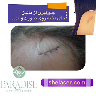 جلوگیری از ماندن جای بخیه روی صورت و بدن