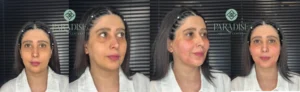 کوکتلهای مزوتراپی و مزونیدلینگ