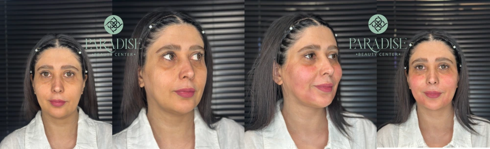 کوکتل‌های مزوتراپی و مزونیدلینگ