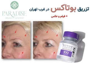 تزریق بوتاکس در غرب تهران ✅ + فیلم و عکس