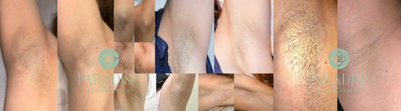 عکس قبل و بعد لیزر زیر بغل