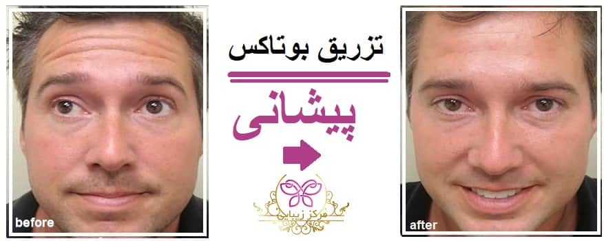 تزریق بوتاکس پیشانی