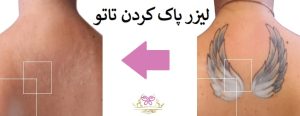 لیزر پاک کردن تاتو