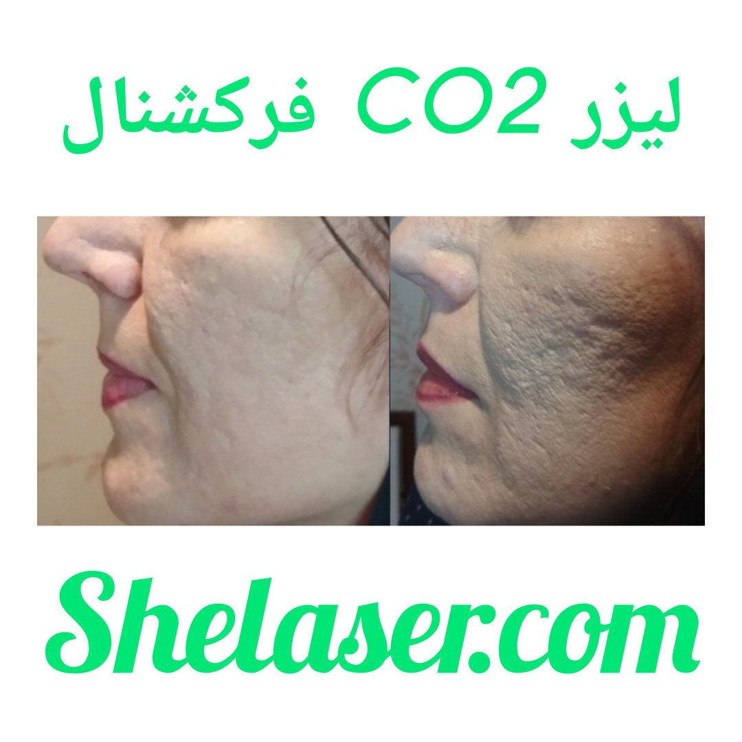 لیزر CO2 فرکشنال