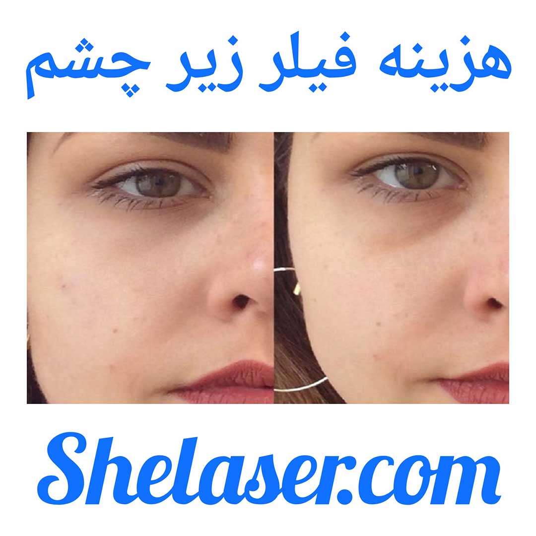 هزینه فیلر زیر چشم