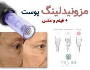 مزونیدلینگ پوست