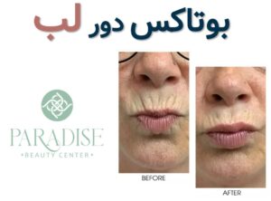 بوتاکس دور لب