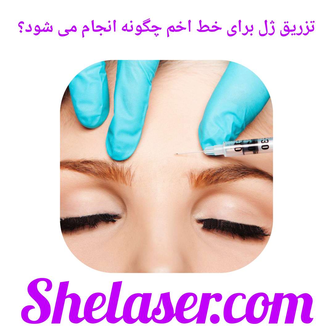 تزریق ژل برای خط لخم چگونه انجام می شود؟