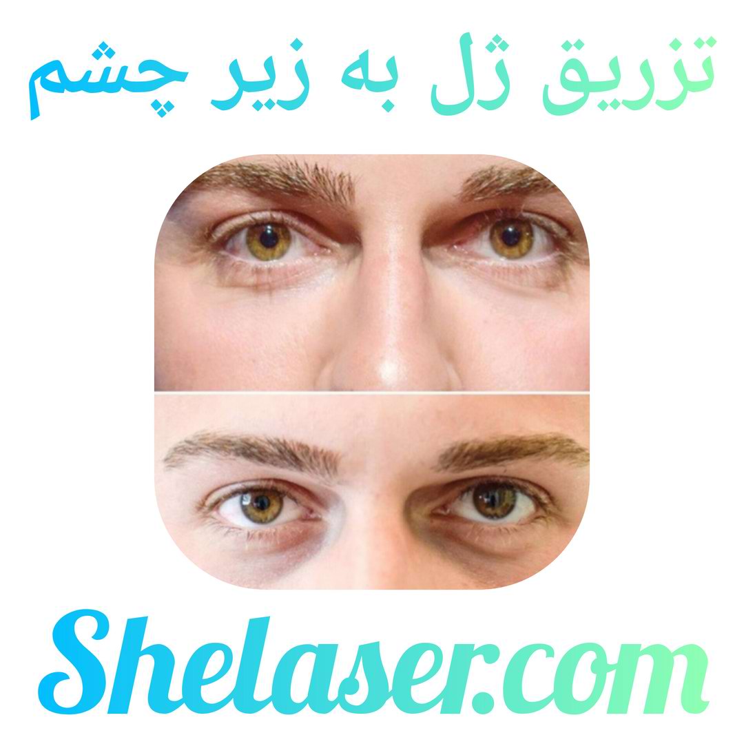 تزریق ژل به زیر چشم