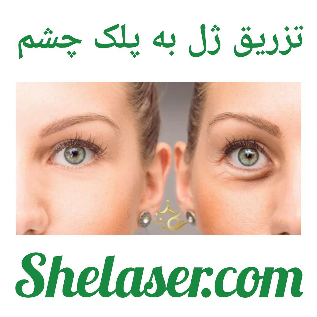 تزریق ژل به پلک چشم