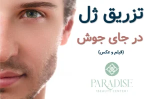 تزریق ژل در جای جوش ✅ + فیلم و عکس