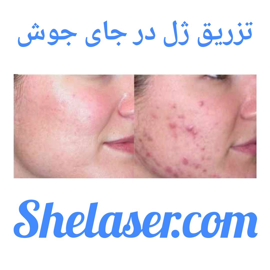 تزریق ژل در جای جوش