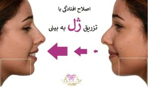 اصلاح افتادگی با تزریق ژل به بینی