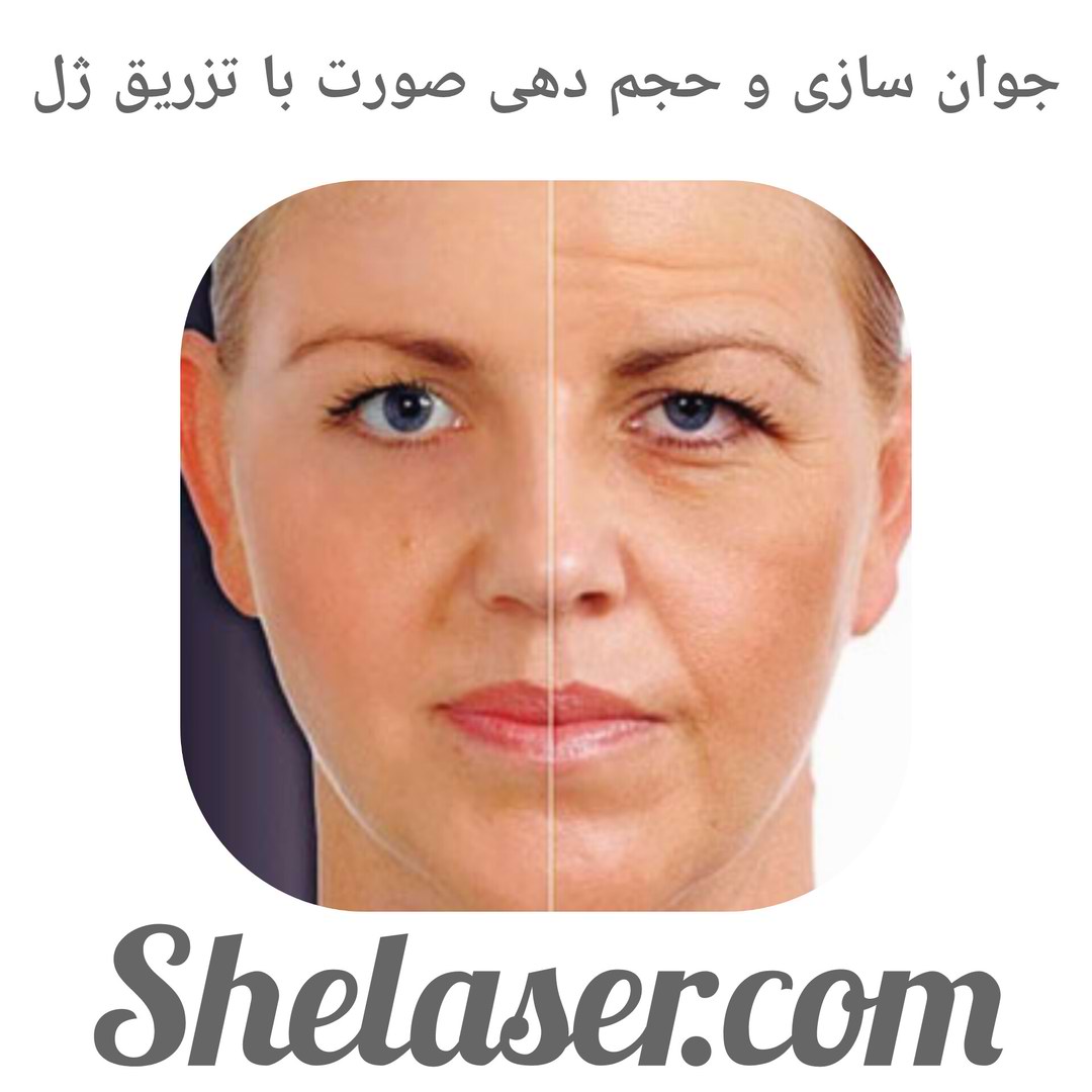 جوان سازی و حجم دهی صورت با تزریق