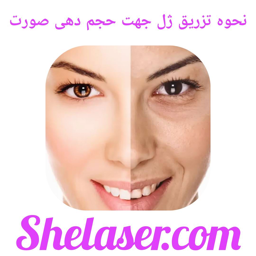 نحوه تزریق ژل جهت حجم دهی صورت