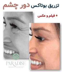 تزریق بوتاکـس دور چشم ✅ + فیلم و عکس