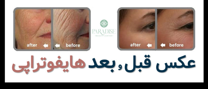 عکس قبل و بعد هایفوتراپی صورت