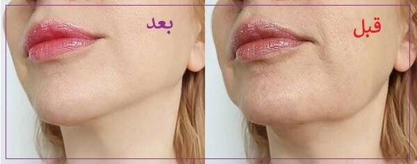 سوالات متداول پیرامون مادلینگ چهره