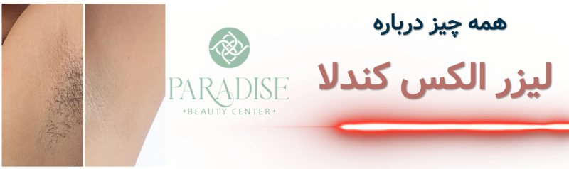 همه چیز درباره لیزر الکس کندلا