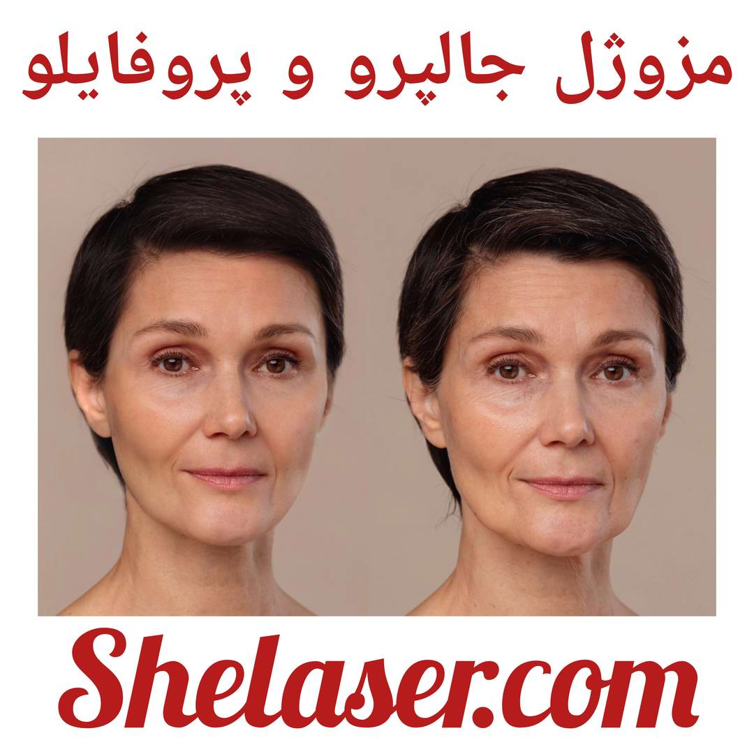 مزوژل جاپرو و پروفایلو