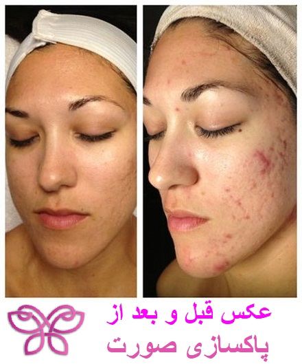 عکس قبل و بعد از پاکسازی پوست صورت