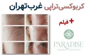کربوکسی تراپی غرب تهران ✅ + فیلم