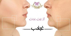 از بین بردن غبغب