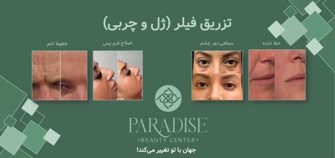 تزریق ژل و چربی در کلینیک پارادایس