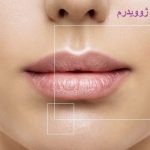 مزایای ژل لب ژوویدرم