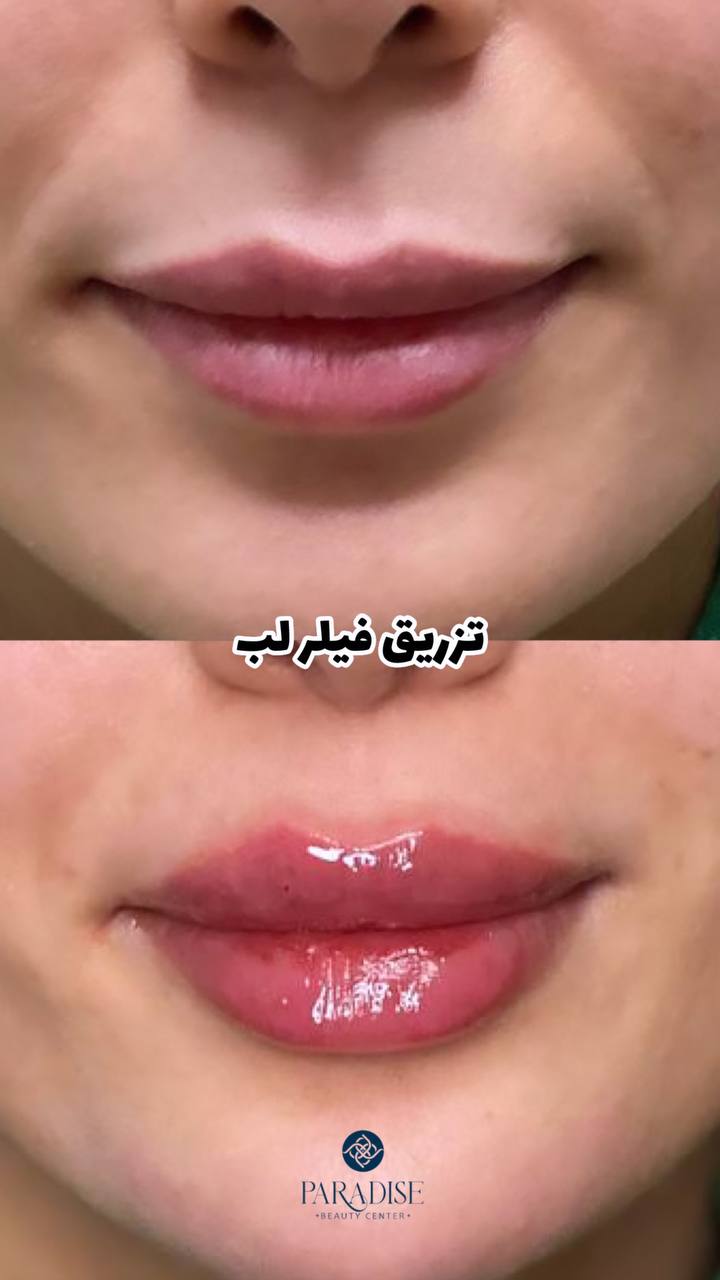 ژل لب کره ای رووفیل