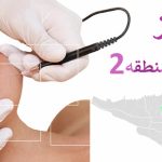 الکترولیز موهای سفید در منطقه 2