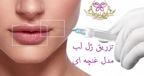 تزریق ژل لب مدل غنچه ای