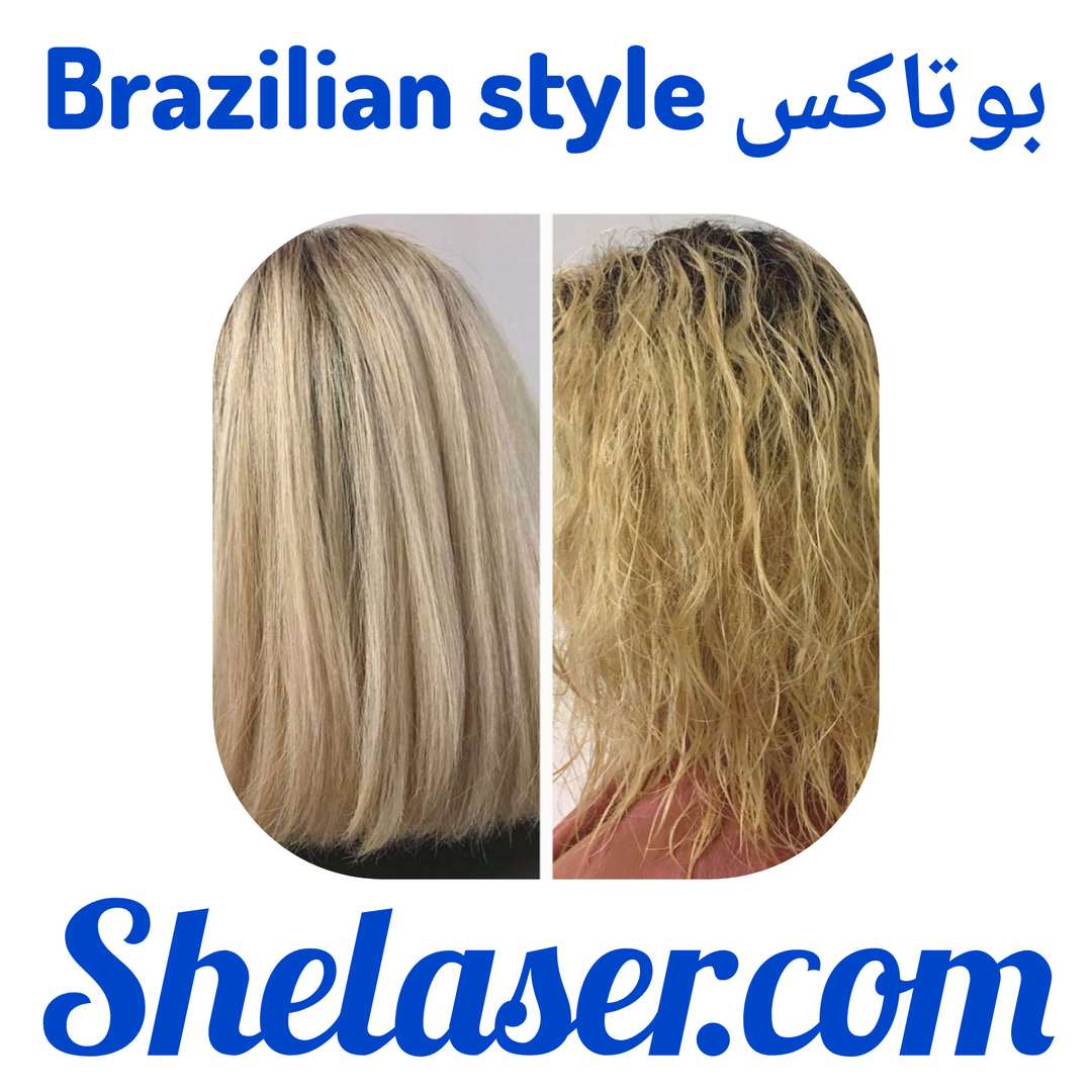 بوتاکس Brazilian style