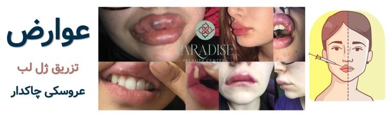 عوارض تزریق ژل لب عروسکی