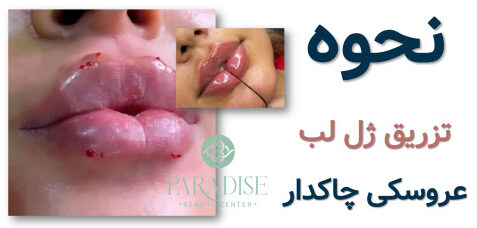 ژل لب عروسکی
