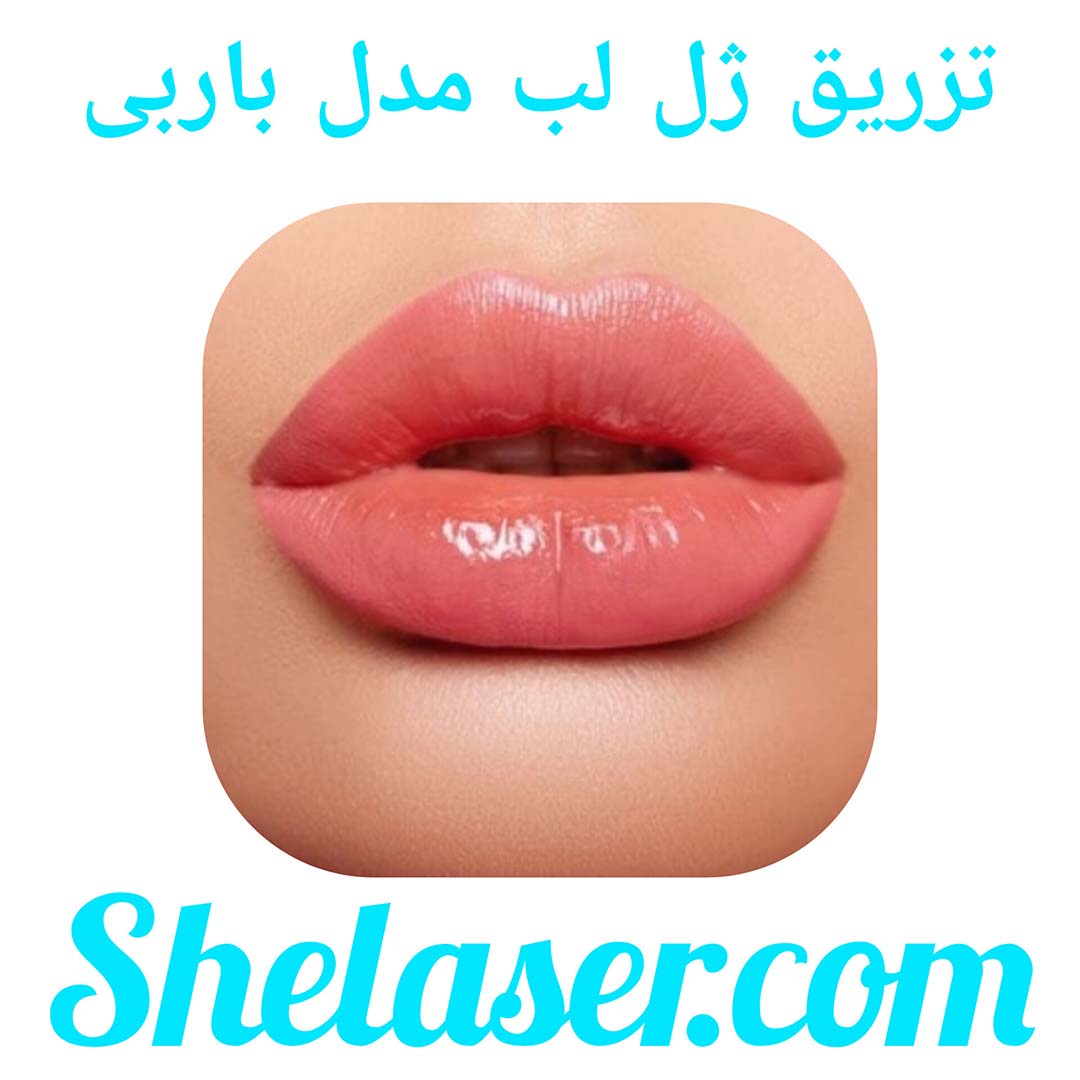 تزریق ژل لب مدل باربی